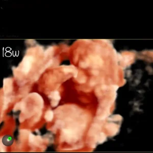 3D pretecho 16 weken, pretecho tilburg